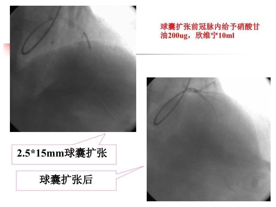 冠状动脉无复流现象的防治.ppt_第5页