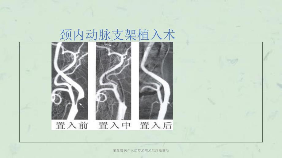 脑血管病介入治疗术前术后注意事项课件_第4页