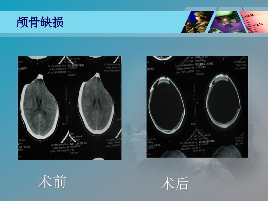 颅骨缺损ppt课件_第4页