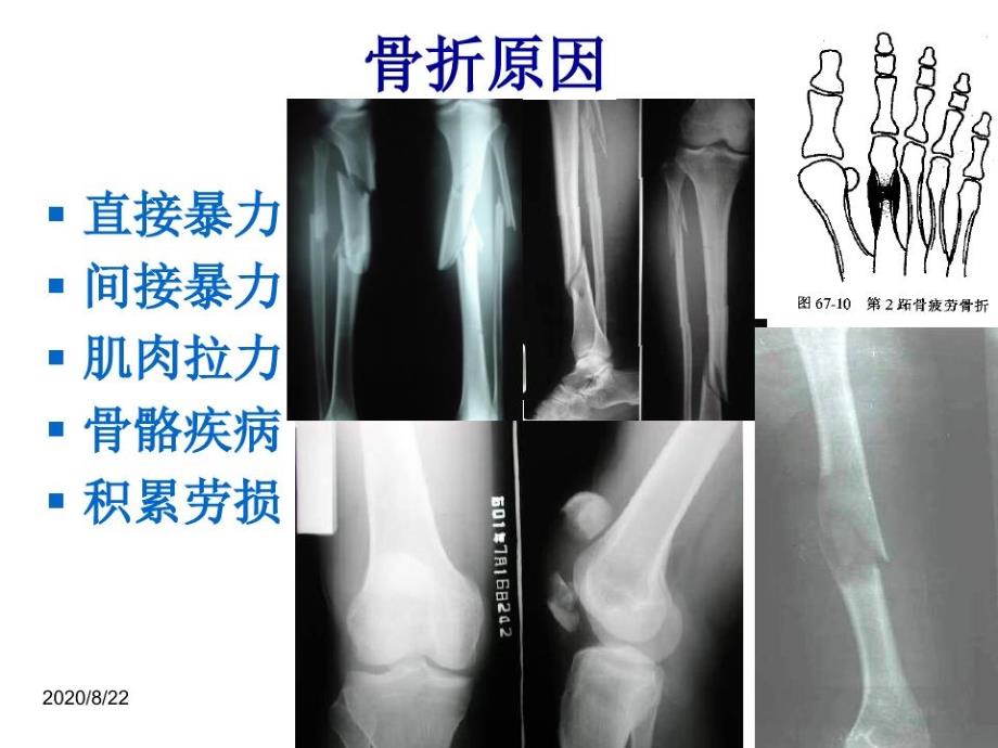 人卫第九版骨科课件-骨折概论65页PPT_第3页