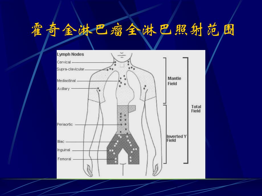 淋巴瘤放疗指南_第3页