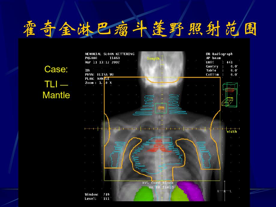 淋巴瘤放疗指南_第4页