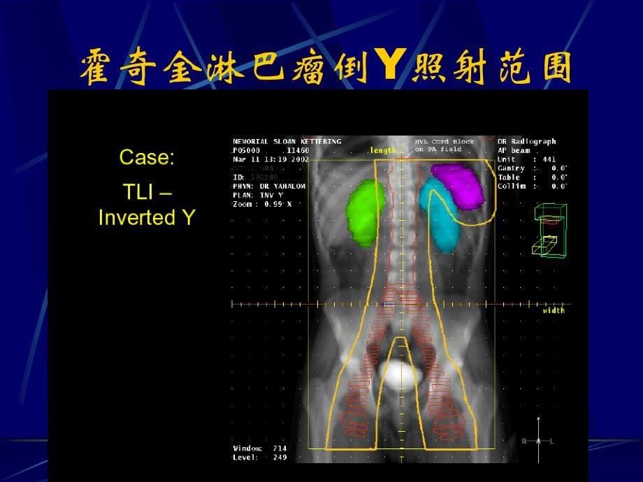 淋巴瘤放疗指南_第5页