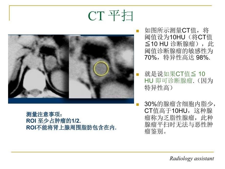 肾上腺占位的CT鉴别诊断_第5页