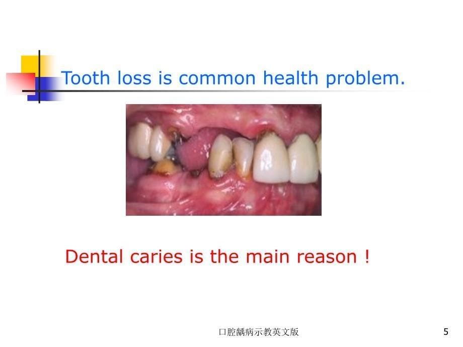 口腔龋病示教英文版培训课件_第5页