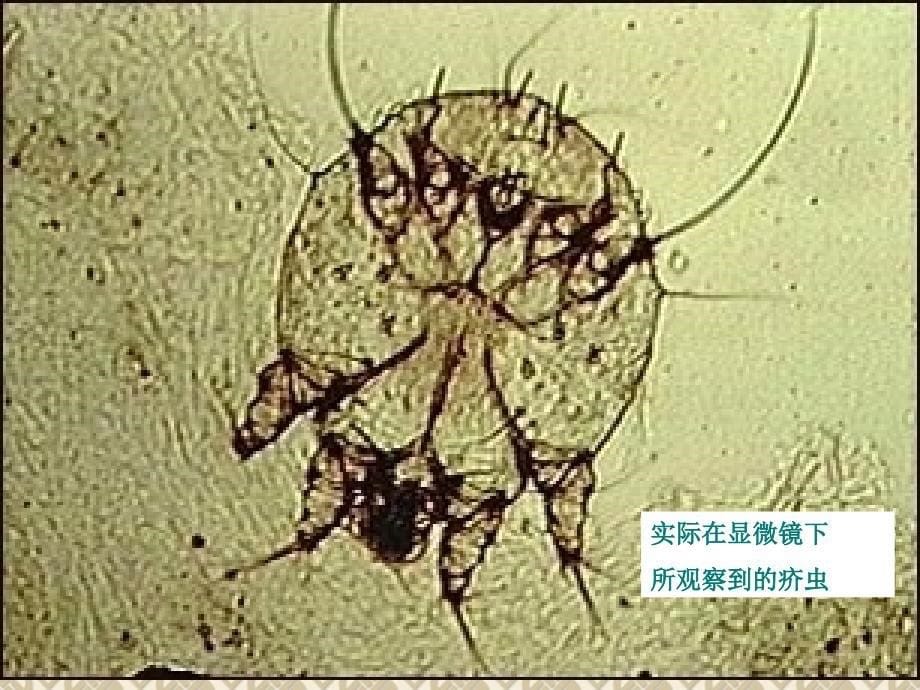 疥疮的防治及治疗_第5页