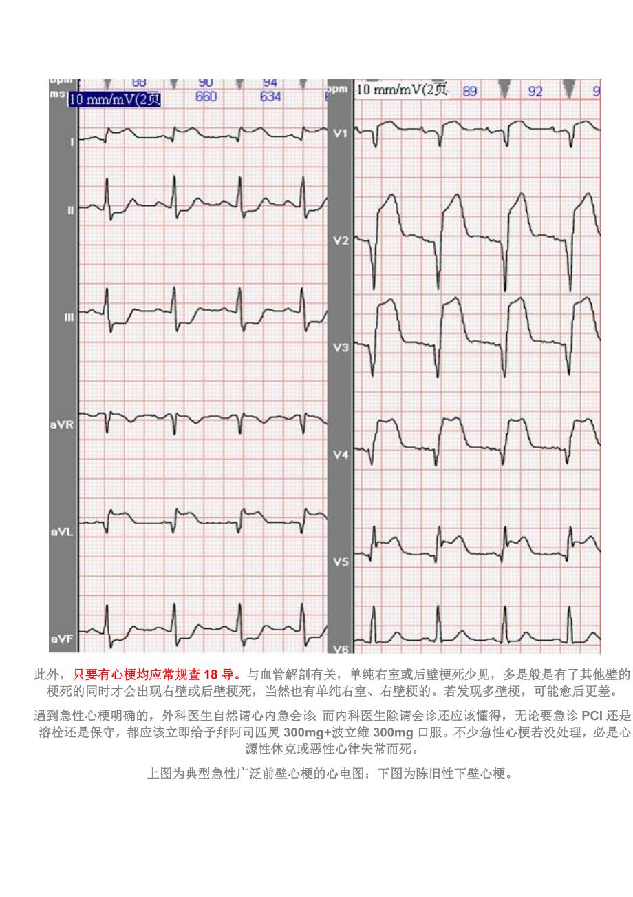 心电图基本讲解_第5页