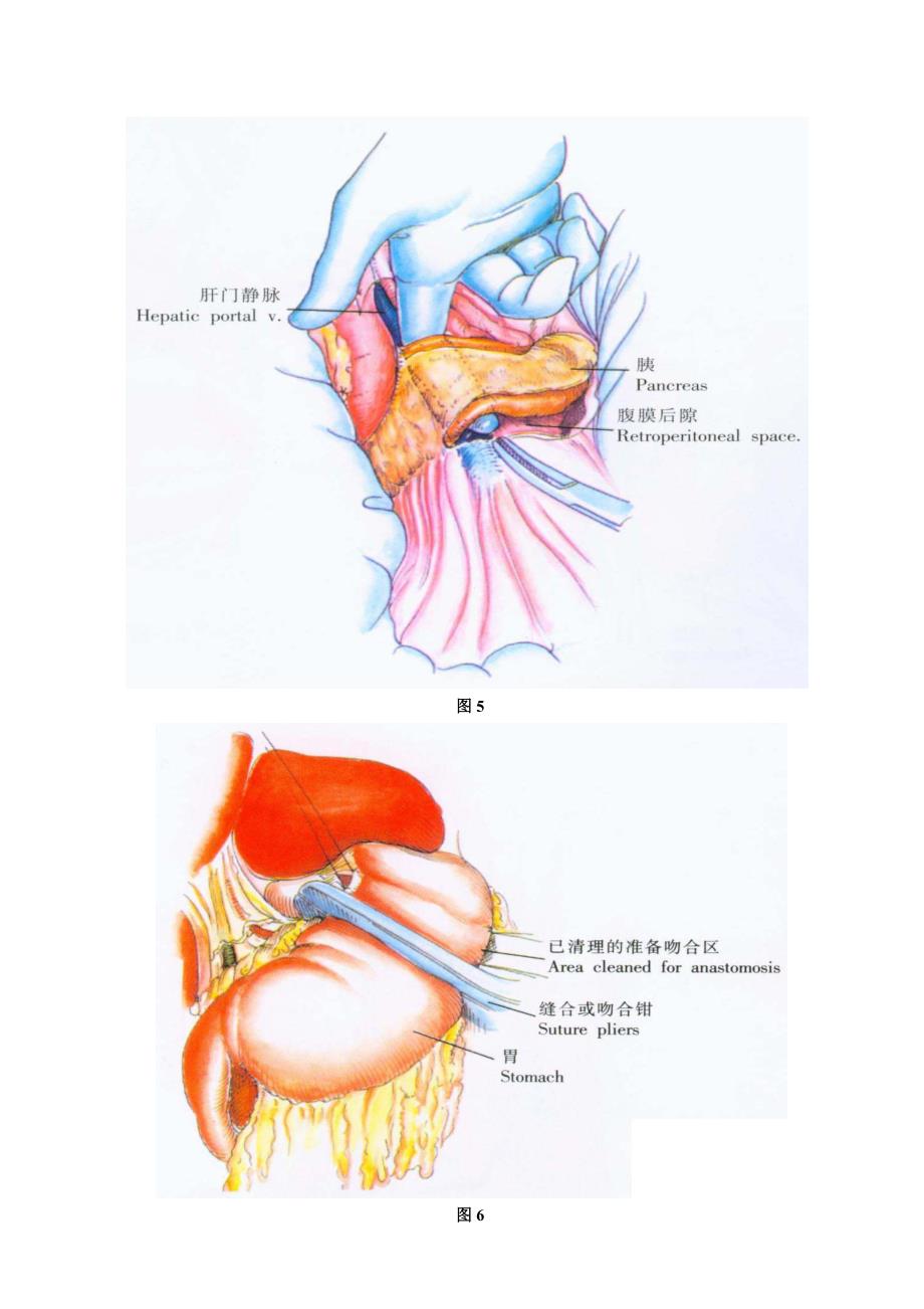 胰腺全切除术_第4页