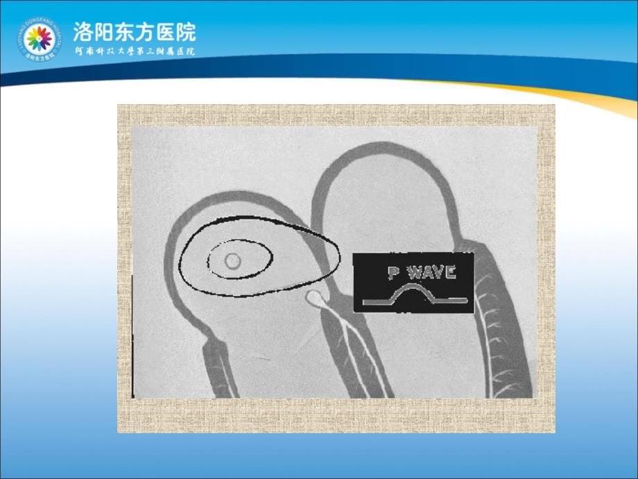 心电图波形诊断法_第5页