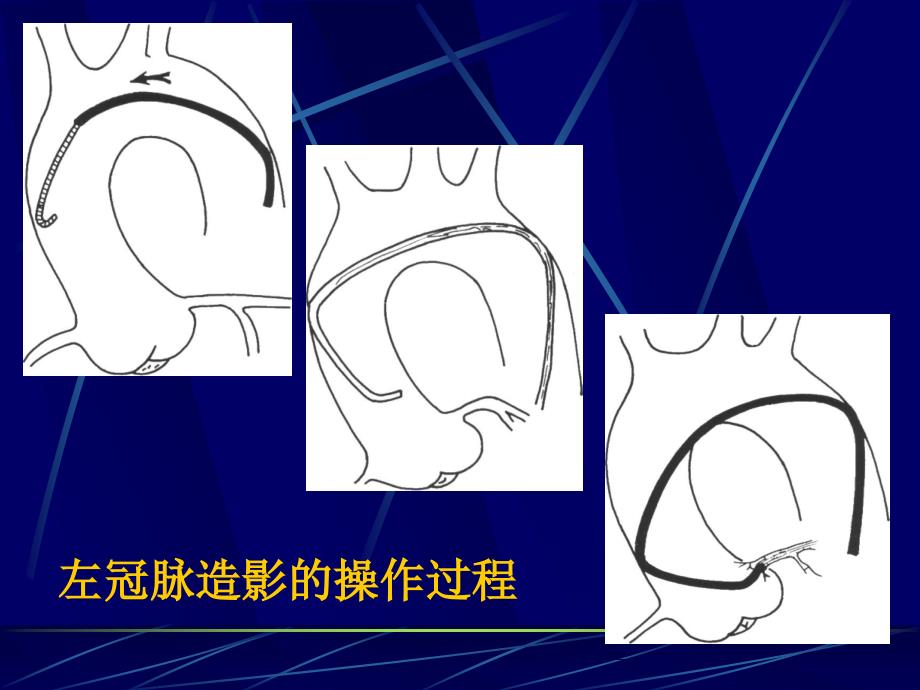 冠脉造影术简装板-绝好资料_第2页