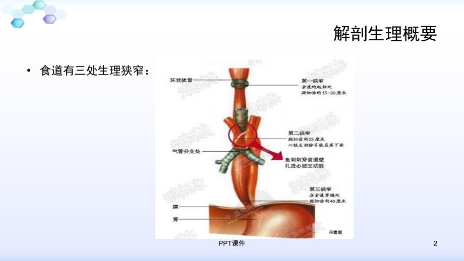 食管癌术后护理--ppt课件_第2页