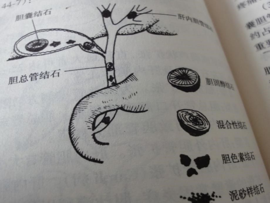 《胆石病的诊断与治》PPT课件_第5页