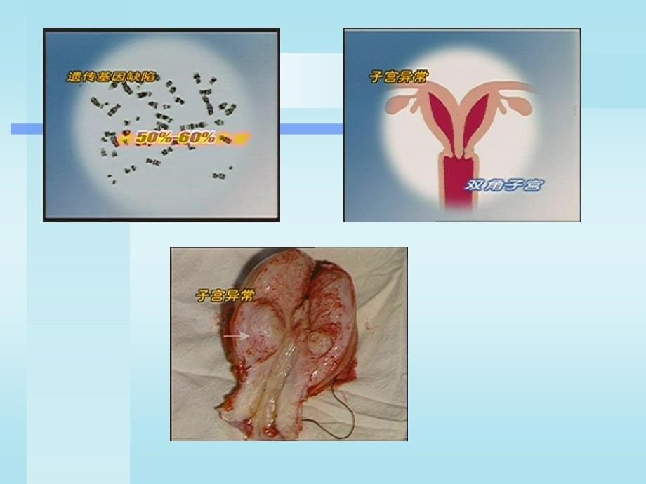 异常妊娠妇女的护理ppt_第5页