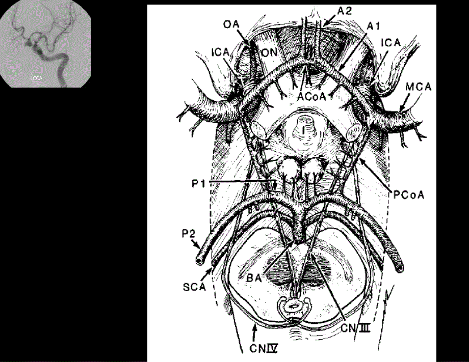 前交通动脉瘤解剖与临床_第4页