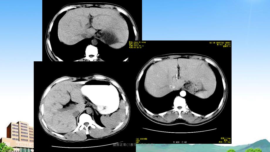 腹部正常CT表现课件分享_第4页