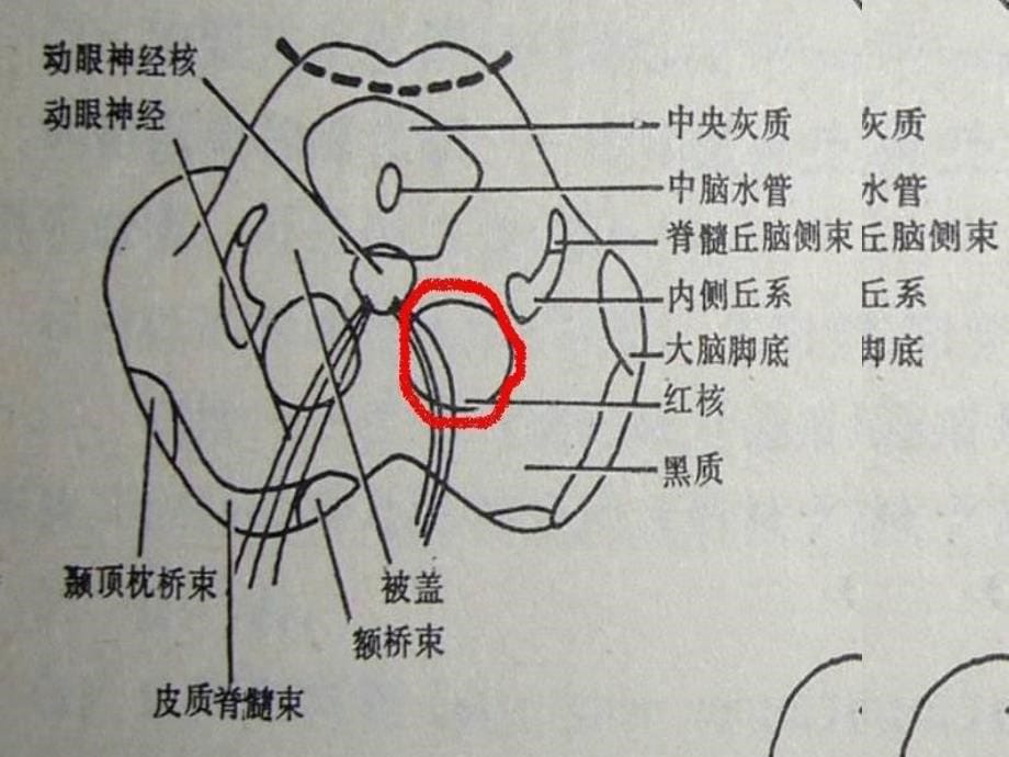 常见的脑干损害综合征模板课件_第5页