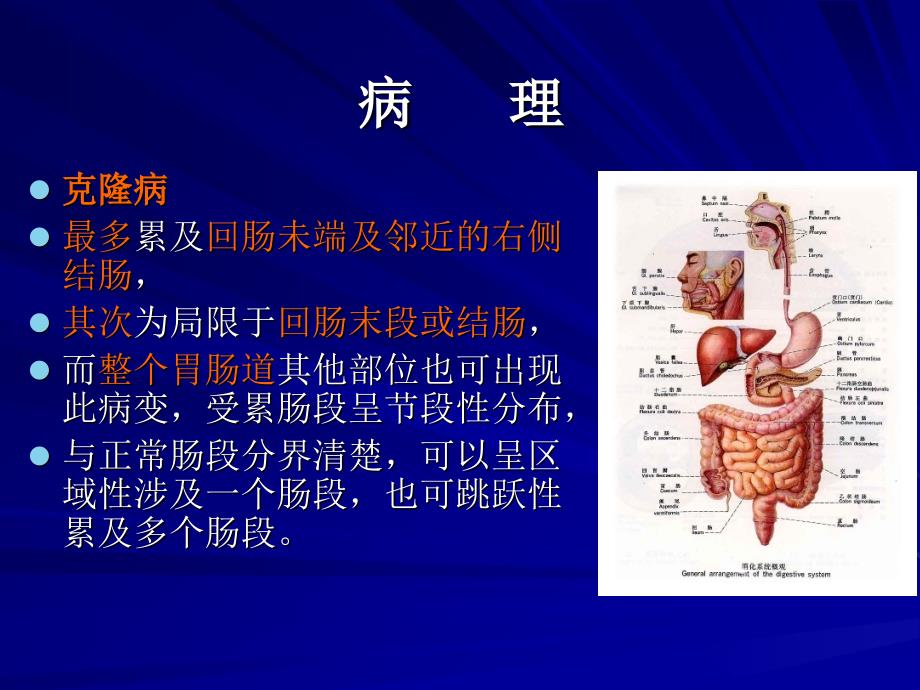 医学专题：克隆病.ppt_第4页