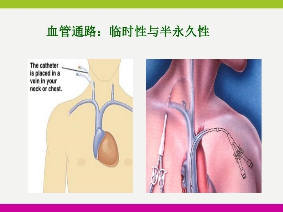 动静脉内瘘的护理ppt_第5页