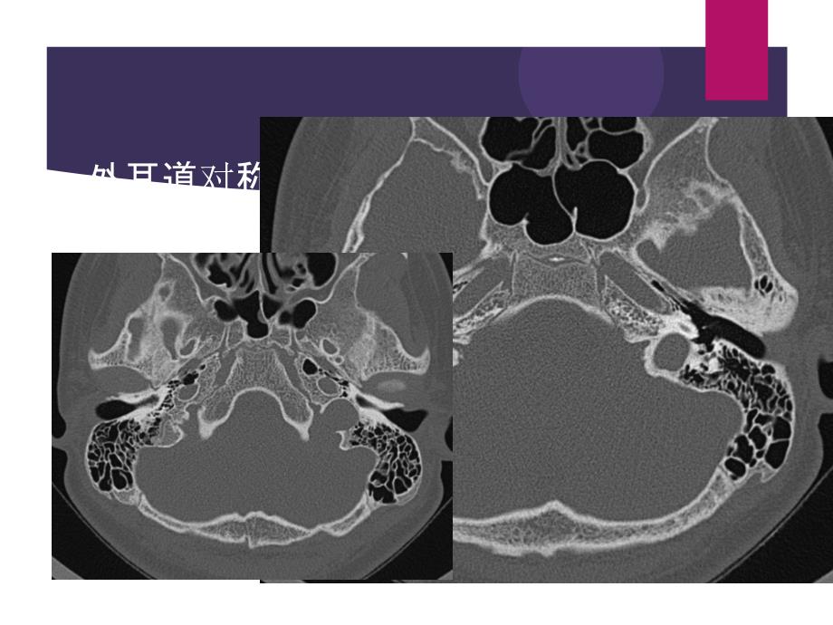 颞骨解剖及中耳炎CT诊断_第2页