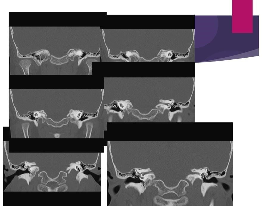颞骨解剖及中耳炎CT诊断_第5页