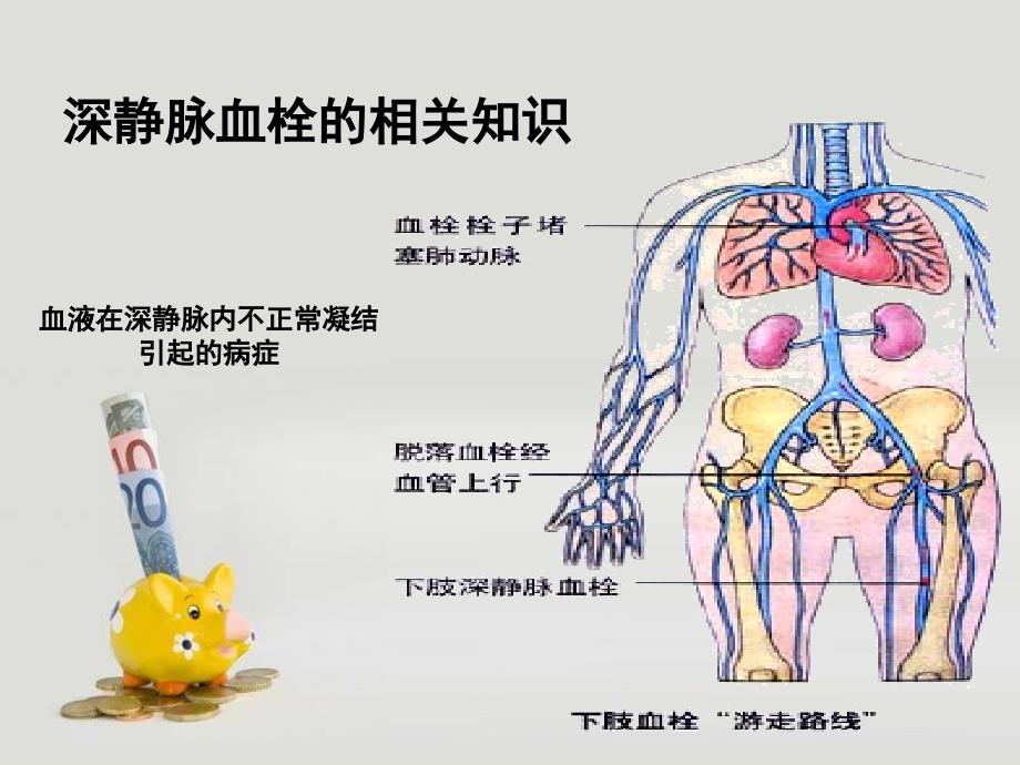 深静脉血栓的护理查房-课件_第3页