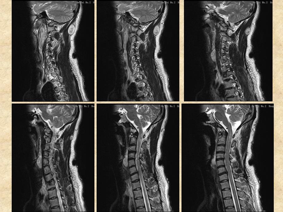 神经纤维瘤病的MR表现一例_第3页