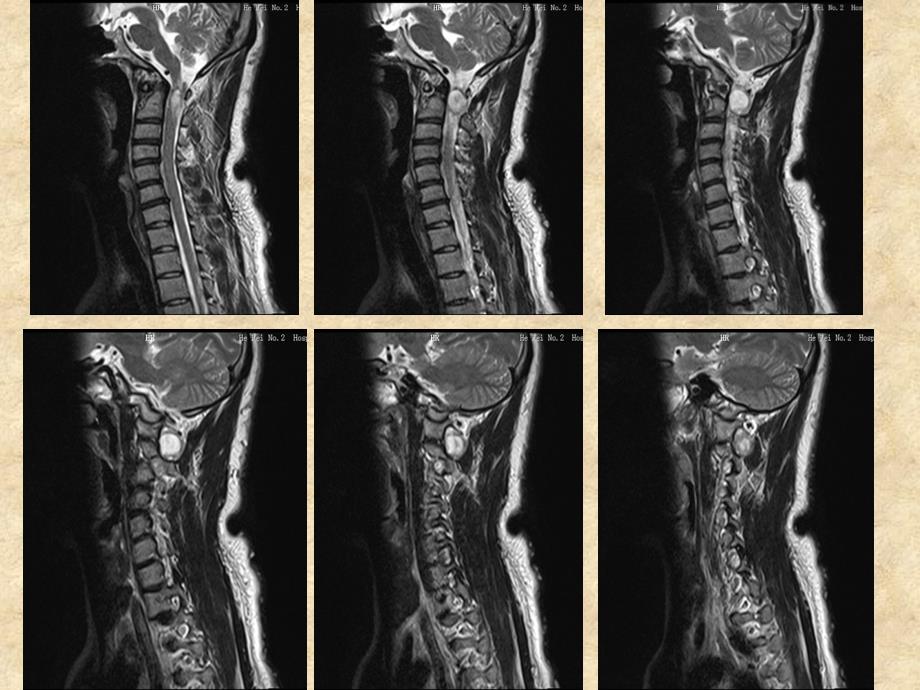 神经纤维瘤病的MR表现一例_第4页