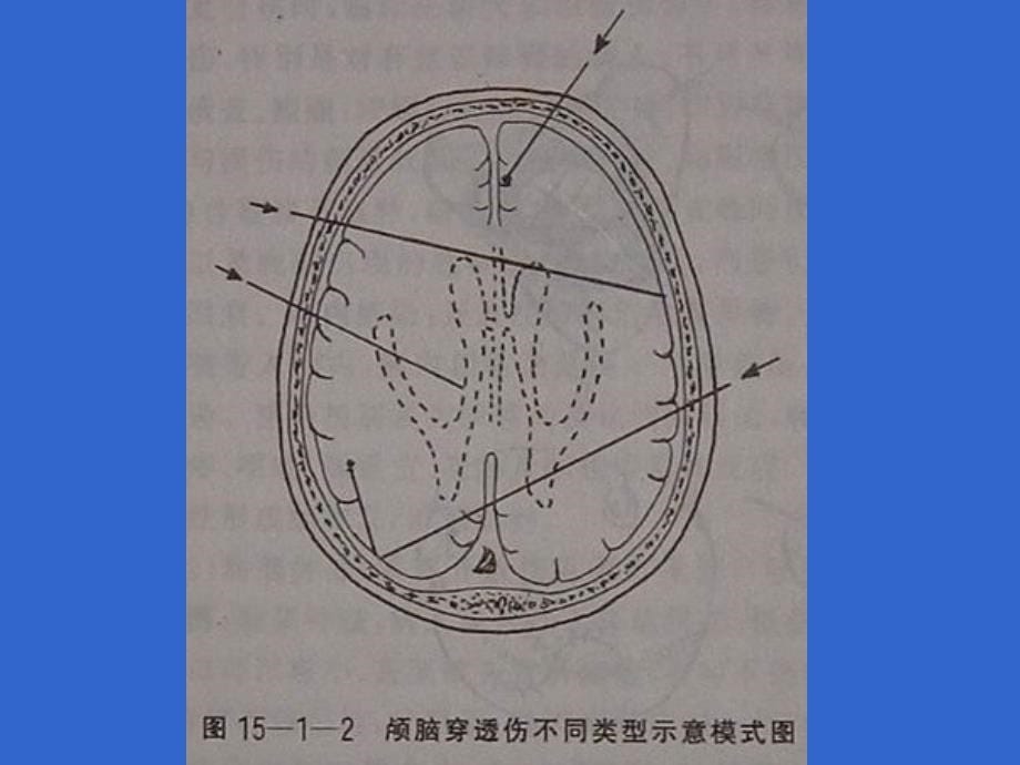 最新：颅脑火器伤文档资料_第5页