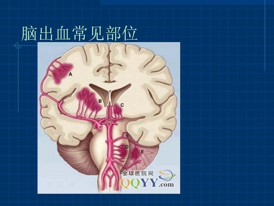 《高血压脑出血手术治疗》课件_第5页