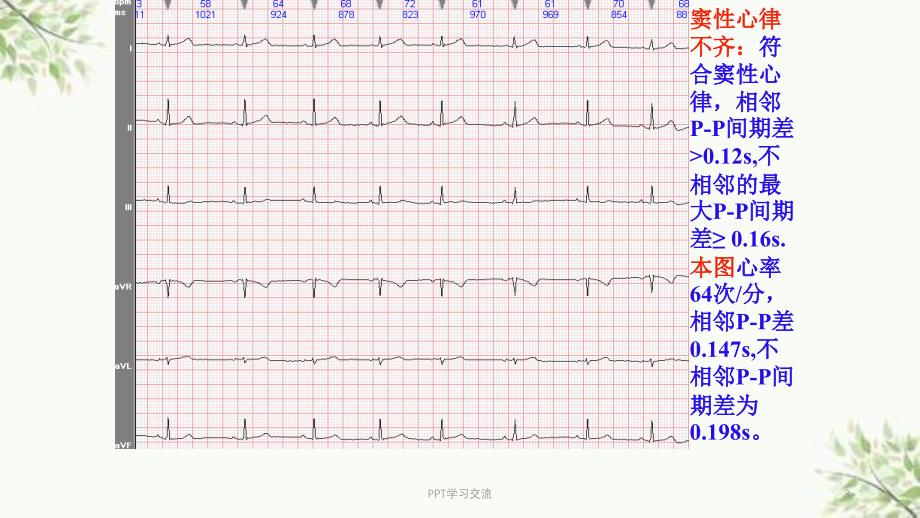 常见心电图诊断课件_第3页