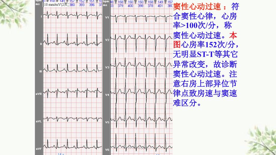 常见心电图诊断课件_第4页