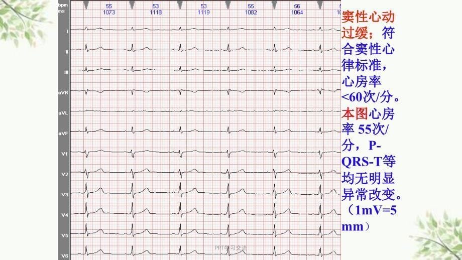 常见心电图诊断课件_第5页