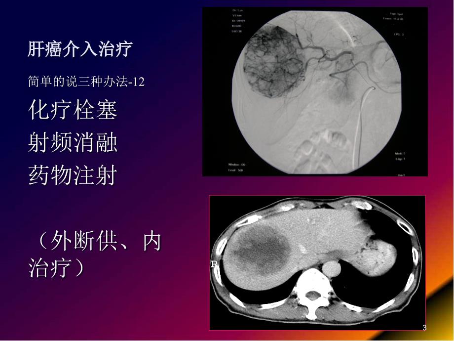 肿瘤介入及综合治疗幻灯片课件_第3页