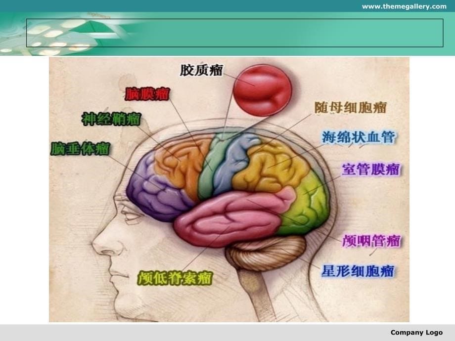 脑胶质瘤基础及治疗探讨上课讲义_第5页