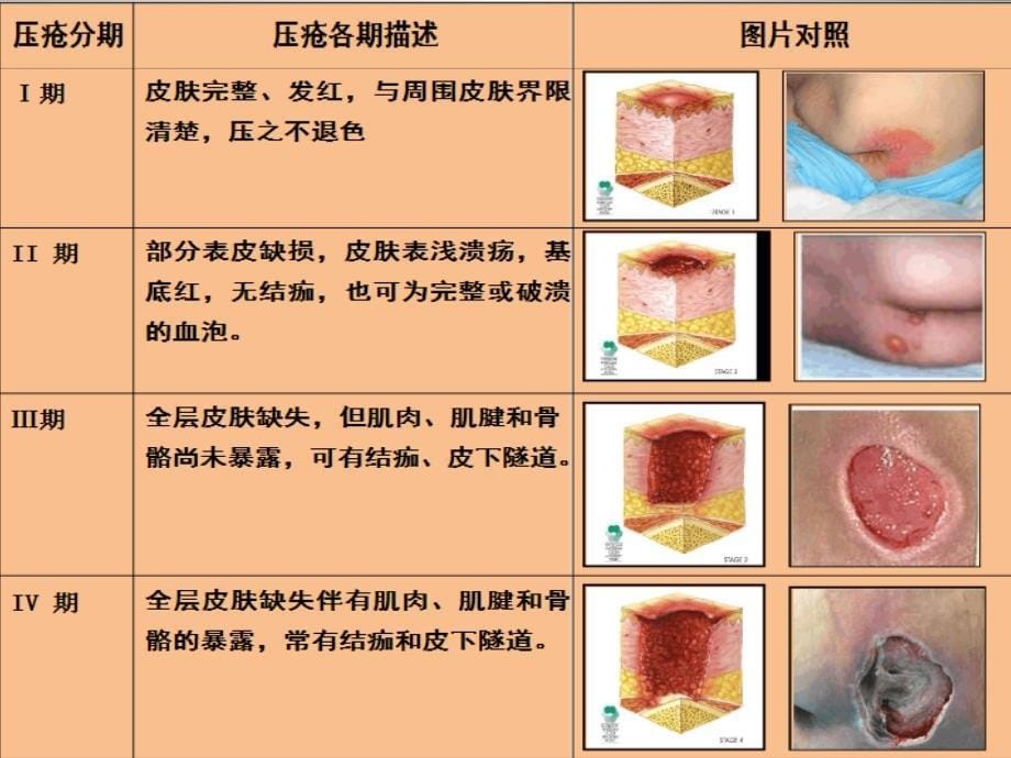 压疮的护理常规PPT_第5页