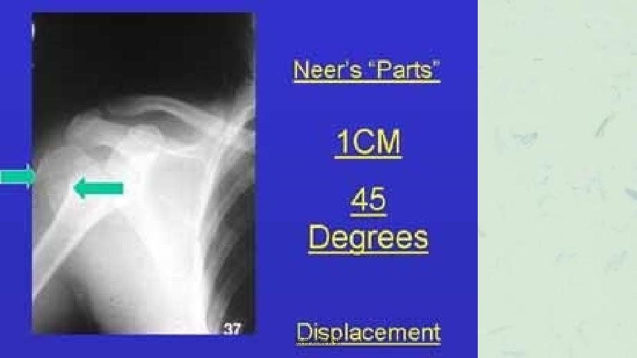 肱骨近端骨折课件_第4页