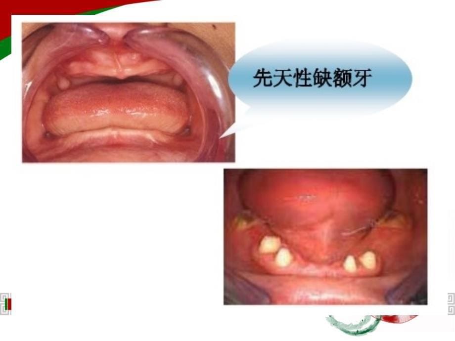 第八章牙发育异常_第5页