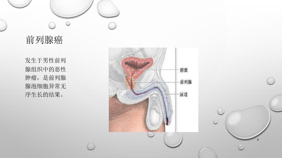 前列腺癌的护理PPT课件_第4页