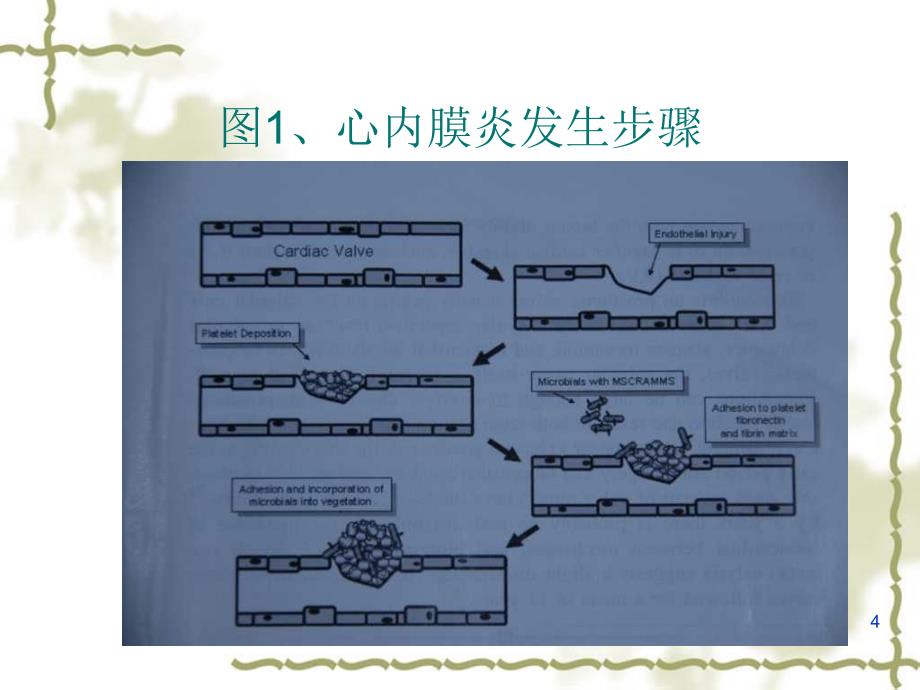 感染性心内膜炎进展及指南_第4页