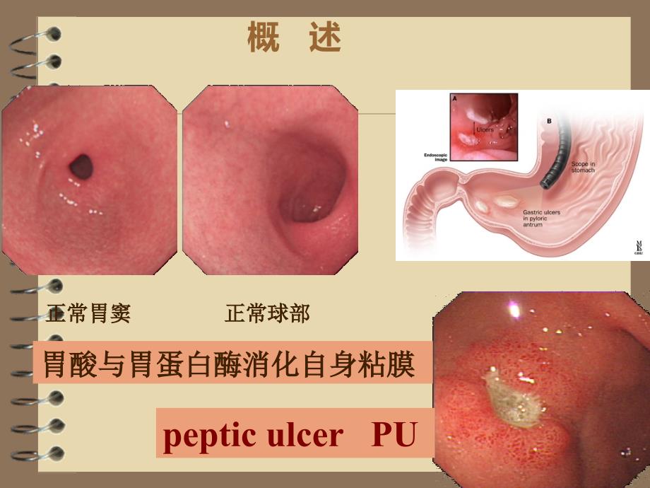 消化性溃疡PPT课件_第4页