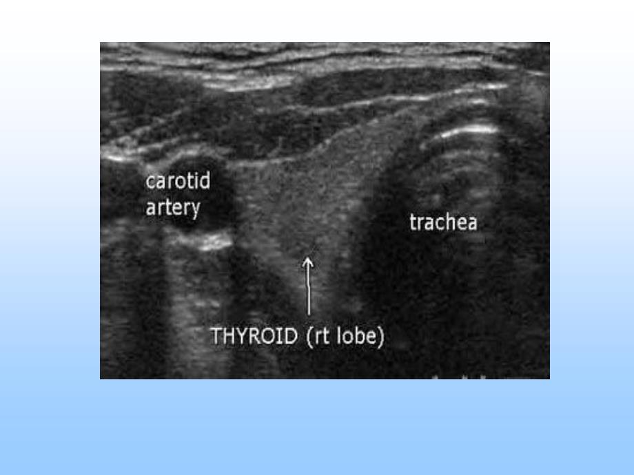 最新甲状腺疾病超声诊断.修改临床医生如何阅读甲状腺疾病超声检查报告单.修改后讲课用_第3页