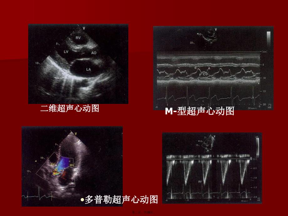 如何解读超声心动图教学文案_第2页