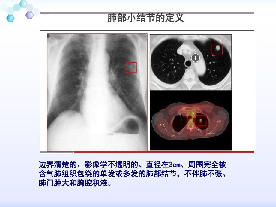 肺小结节_第4页