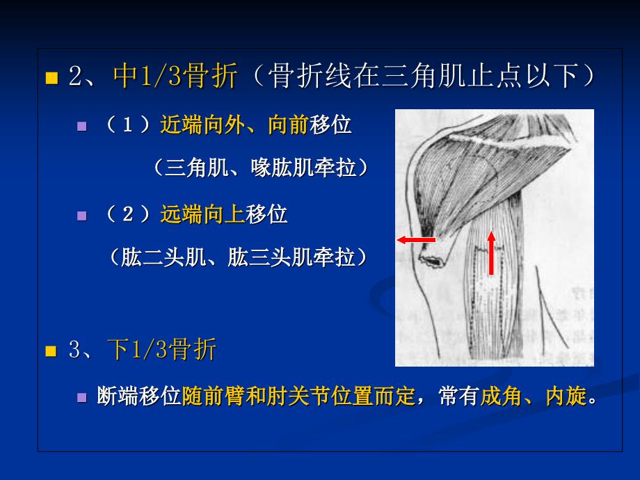 伤科肱骨干骨折PPT课件_第4页