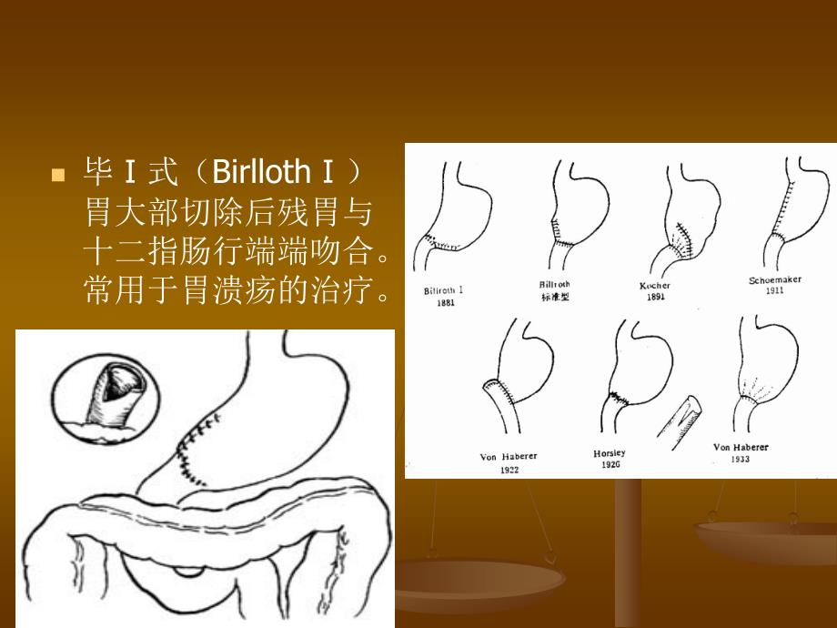 胃大部切除术后并发症及其防治_第3页