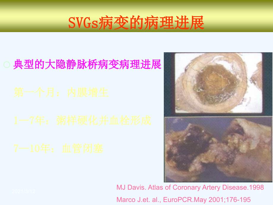 CABG术后血管病变的介入治疗课件_第3页