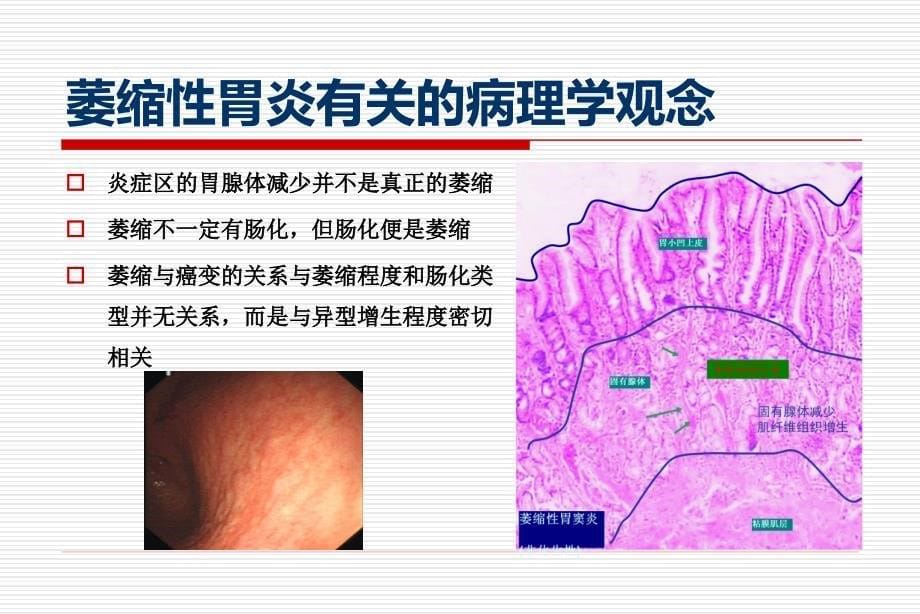 胃上皮内瘤变治疗与评价课件_第5页