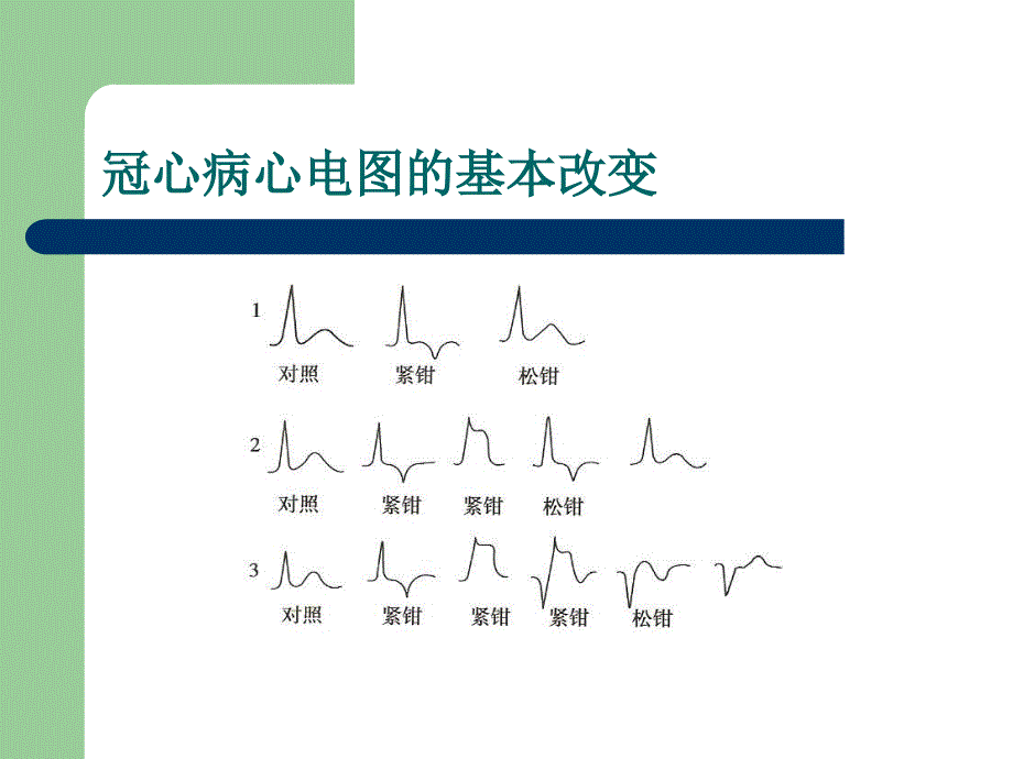 通过心电图识别病变冠状动脉-365心血管网_第4页