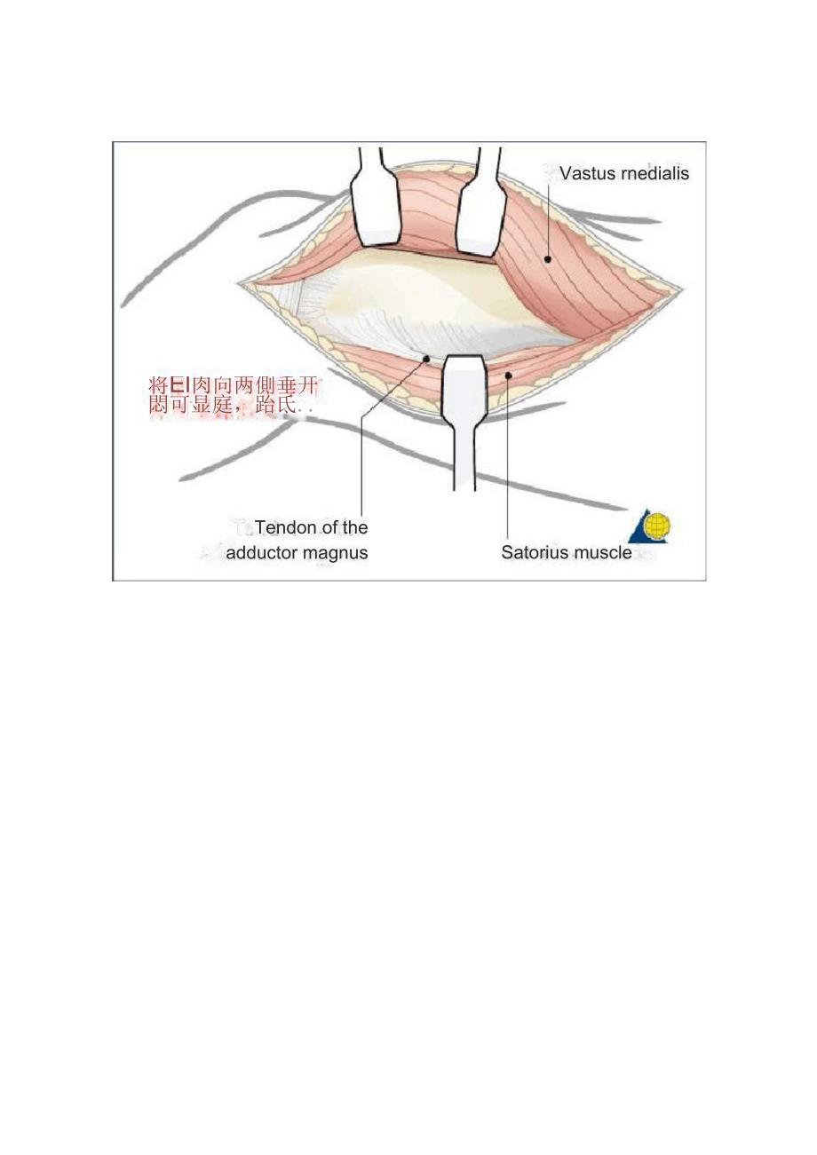 股骨远端内侧手术入路_第3页