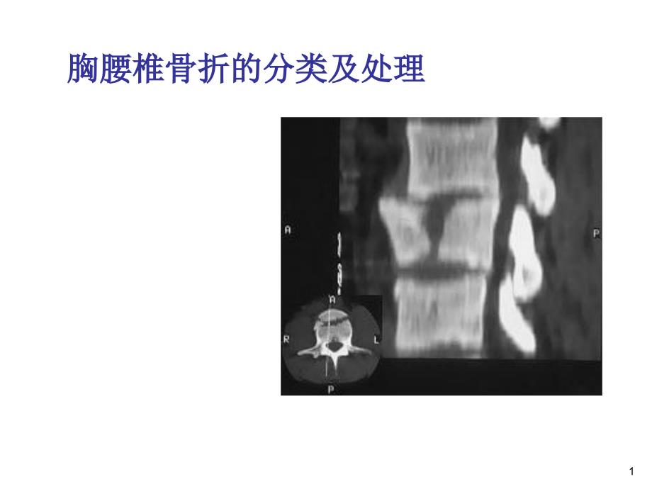 胸腰椎骨折ppt课件_第1页